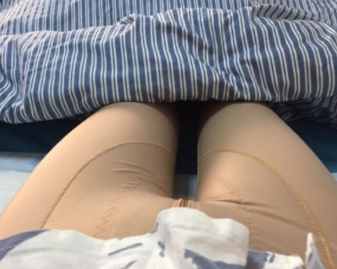 吸脂减肥
