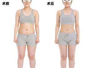 超声波减肥