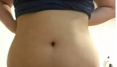 吸脂减肥
