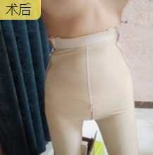 超声波减肥