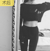 超声波减肥