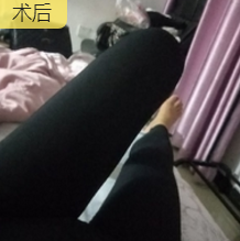 超声波减肥
