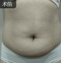 吸脂减肥
