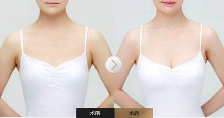 吸脂减肥