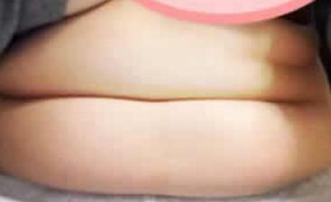 超声波减肥