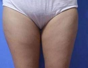 超声波减肥