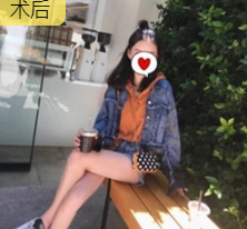 吸脂减肥