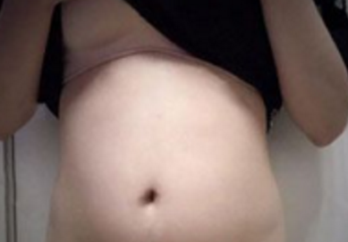 超声波减肥