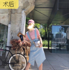 吸脂减肥