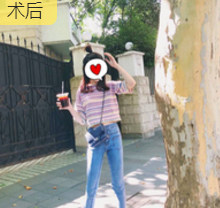 吸脂减肥