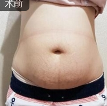 超声波减肥