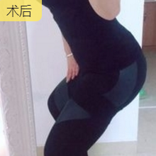 超声波减肥