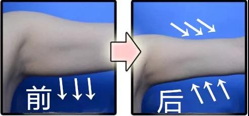 超声波减肥