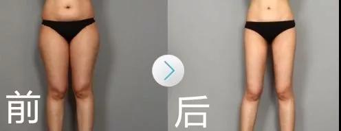 超声波减肥