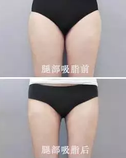 超声波减肥
