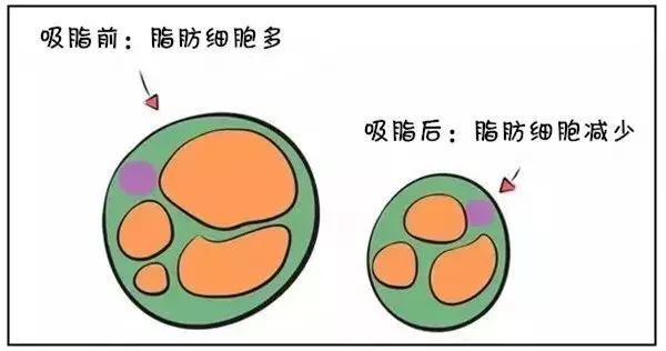 超声波减肥