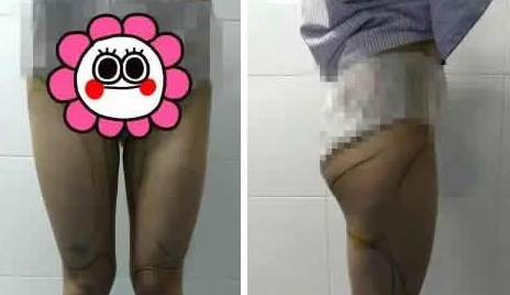 超声波减肥
