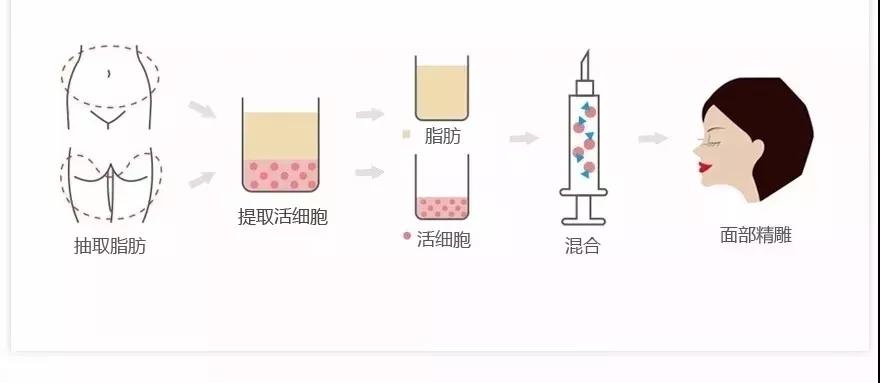 吸脂减肥
