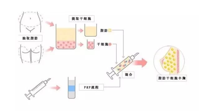 吸脂减肥