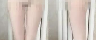 超声波减肥