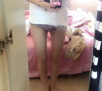 超声波减肥