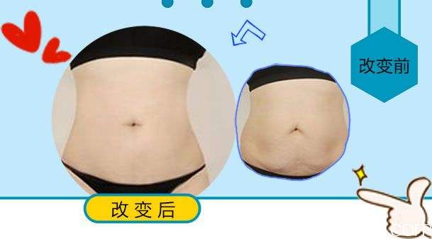 吸脂减肥