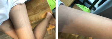 超声波减肥