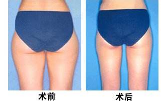 超声波减肥