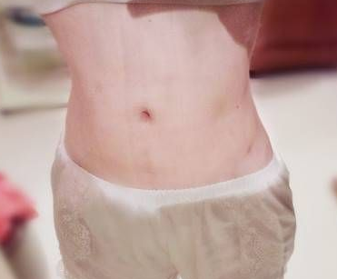 超声波减肥