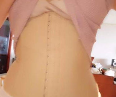 超声波减肥
