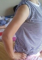 超声波减肥