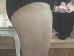 超声波减肥